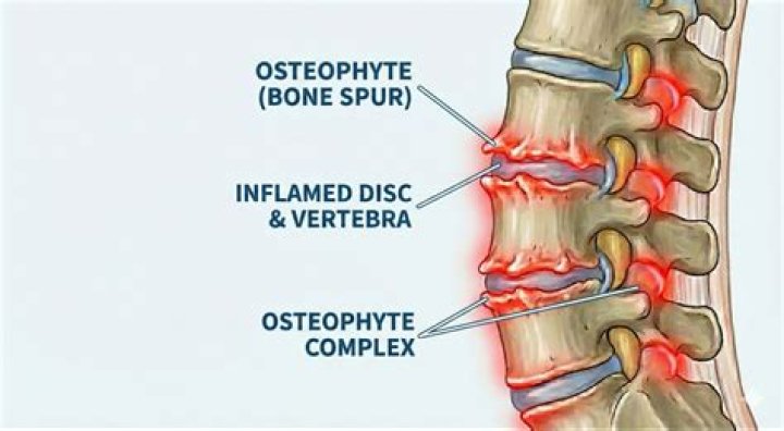 disc osteophyte complex