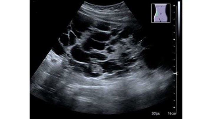 hypoechoic mass