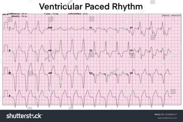 ventricular paced rhythm
